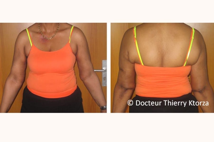 chirurgie esthetique lifting bras cicactrices chirurgie esthetique lifting bras cicactrices