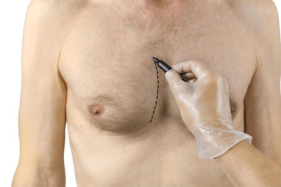gynecomastie chirurgie esthetique homme dr thierry ktorza specialiste medecine esthetique paris
