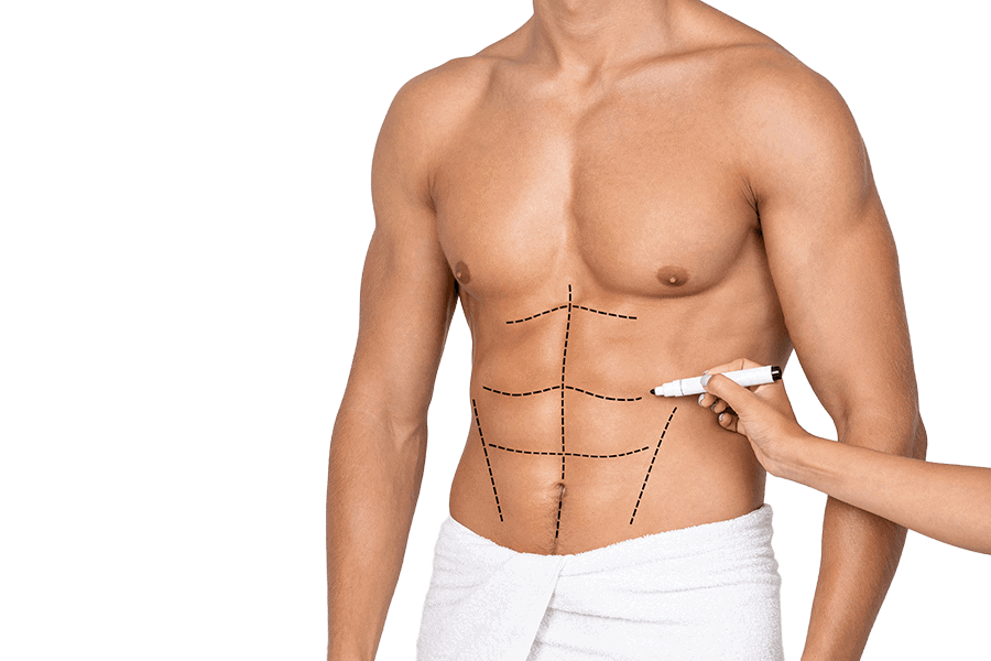 liposculpture abdominale chirurgie esthetique homme dr thierry ktorza specialiste medecine esthetique paris