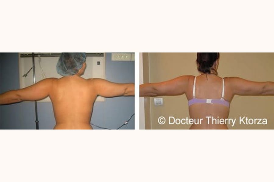 liposuccion avant apres bras femme liposuccion avant apres bras femme