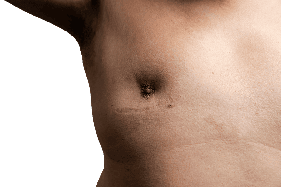 mamelons ombiliques chirurgie esthetique femme poitrine teton rentre dr thierry ktorza specialiste medecine esthetique paris mamelons ombiliques chirurgie esthetique femme poitrine teton rentre dr thierry ktorza specialiste medecine esthetique paris