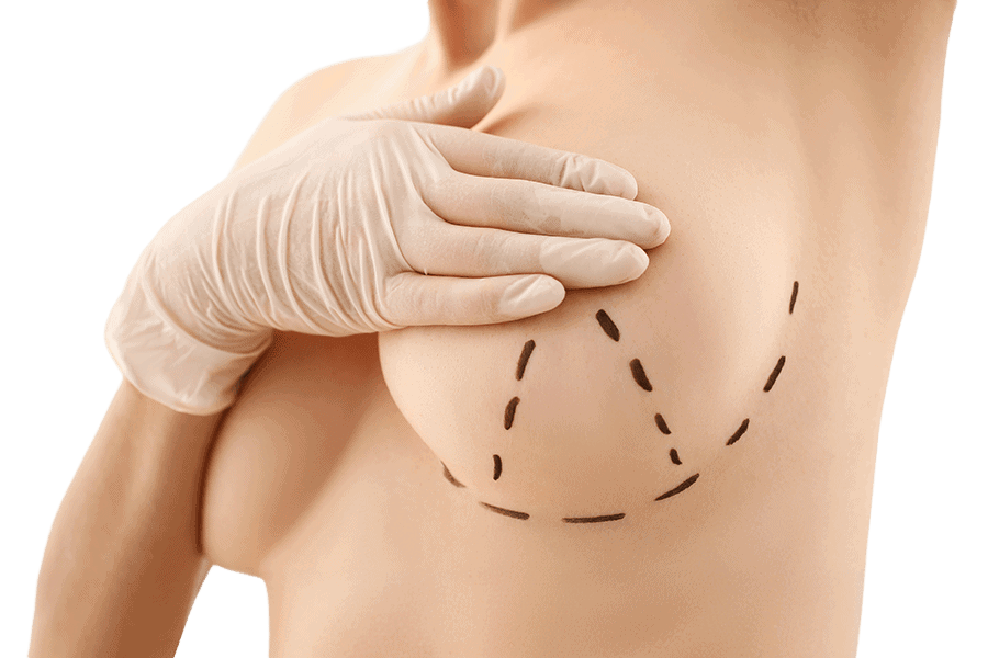 mastopexie lifting mammaire chirurgie esthetique femme poitrine seins tombants dr thierry ktorza specialiste medecine esthetique paris mastopexie lifting mammaire chirurgie esthetique femme poitrine seins tombants dr thierry ktorza specialiste medecine esthetique paris