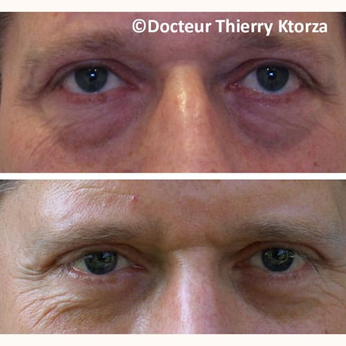 photo avant apres blepharoplastie homme voie conjonctivale photo avant apres blepharoplastie homme voie conjonctivale
