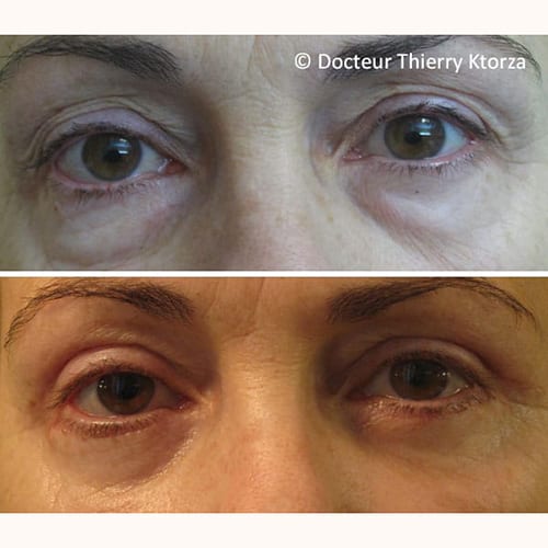photo avant apres blepharoplastie inferieure femme 65 ans photo avant apres blepharoplastie inferieure femme 65 ans