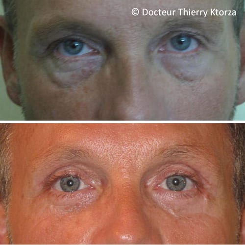 photo avant apres blepharoplastie paupieres homme 52 ans photo avant apres blepharoplastie paupieres homme 52 ans