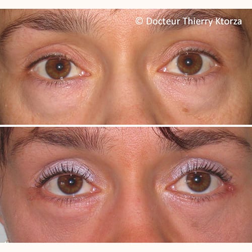 photo avant apres blepharoplastie paupieres inferieures femme 29 ans photo avant apres blepharoplastie paupieres inferieures femme 29 ans