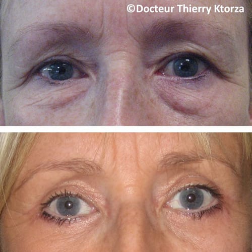 photo avant apres blepharoplastie paupieres superieure inferieure femme photo avant apres blepharoplastie paupieres superieure inferieure femme