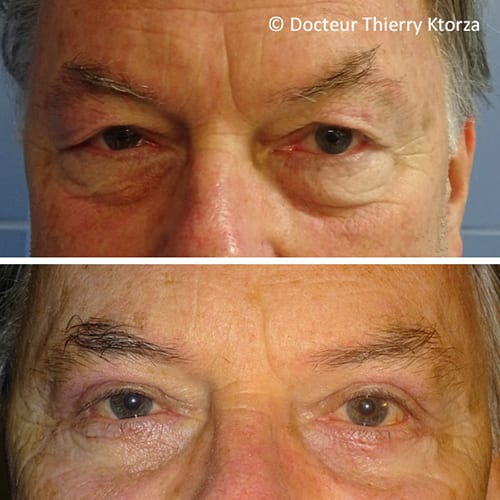 photo avant apres blepharoplastie paupieres superieures inferieures homme 63 ans photo avant apres blepharoplastie paupieres superieures inferieures homme 63 ans