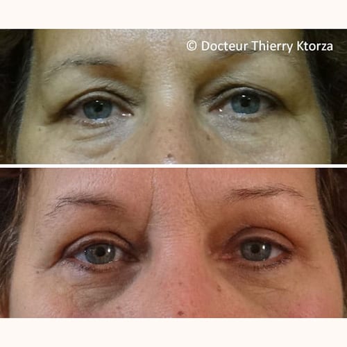 photo avant apres blepharoplastie paupieres superieures inferieures photo avant apres blepharoplastie paupieres superieures inferieures