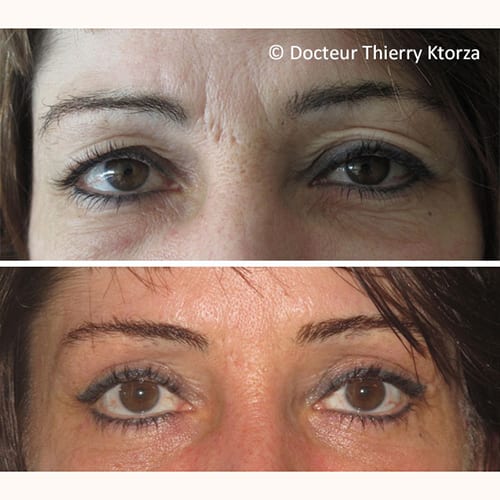 photo avant apres blepharoplastie paupieres superieures photo avant apres blepharoplastie paupieres superieures