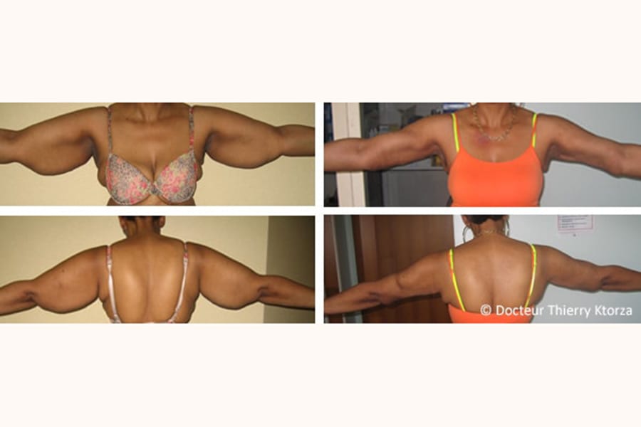 photo avant apres lifting bras amaigrissement massif photo avant apres lifting bras amaigrissement massif