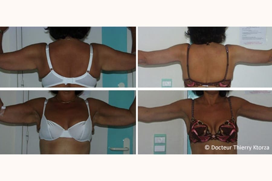 photo avant apres lifting bras perte de poids photo avant apres lifting bras perte de poids