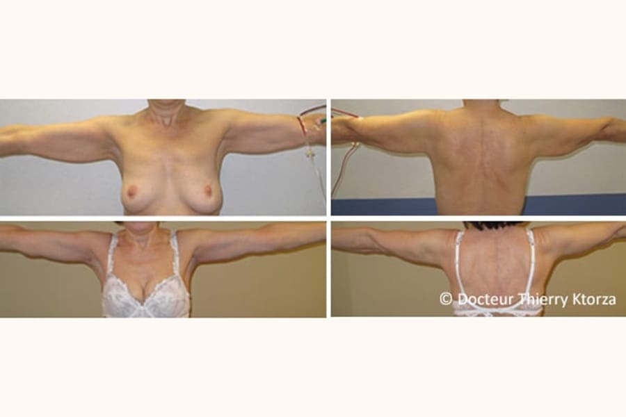 photo avant apres lifting bras ptose mammaire photo avant apres lifting bras ptose mammaire