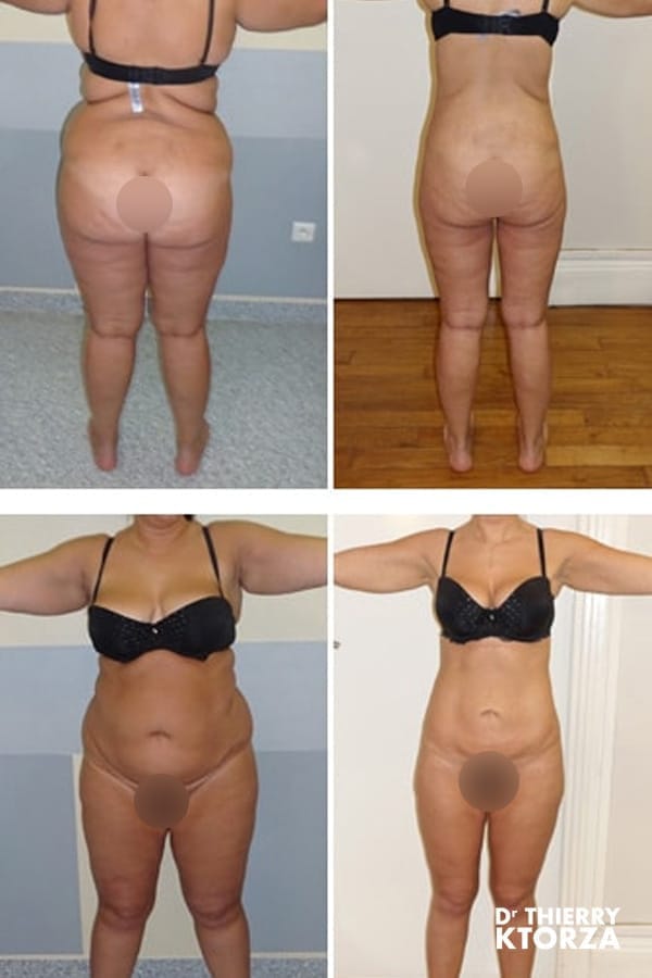 photo avant apres liposuccion ktorza paris 17 photo avant apres liposuccion ktorza paris 17