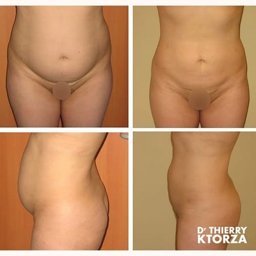 photo avant apres liposuccion ktorza paris 19 photo avant apres liposuccion ktorza paris 19