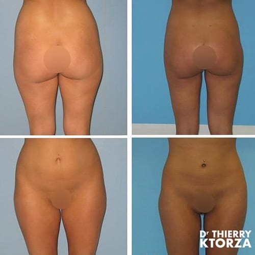 photo avant apres liposuccion ktorza paris 21 photo avant apres liposuccion ktorza paris 21