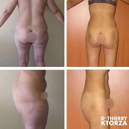 photo avant apres liposuccion ktorza paris 23 photo avant apres liposuccion ktorza paris 23