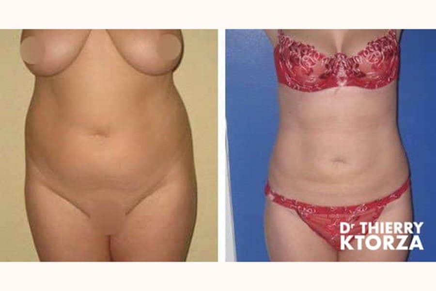 photo avant apres liposuccion ktorza paris 5 photo avant apres liposuccion ktorza paris 5