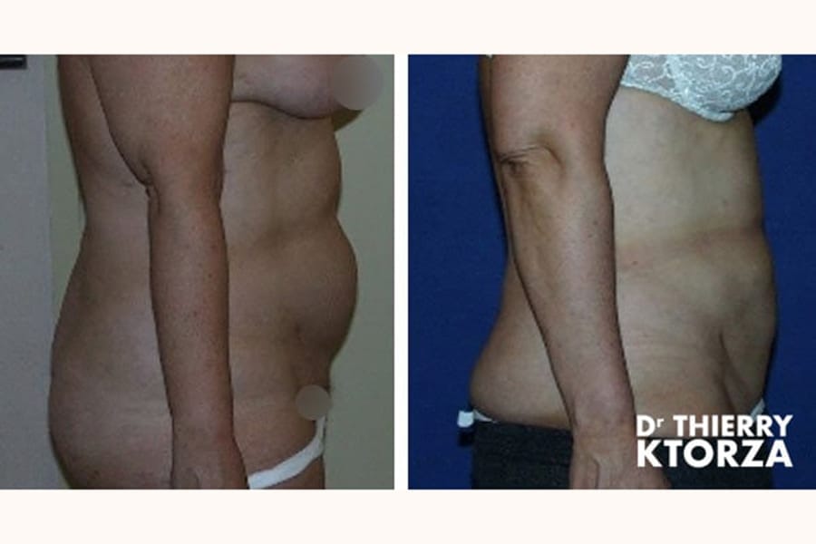 photo avant apres liposuccion ktorza paris 6 photo avant apres liposuccion ktorza paris 6