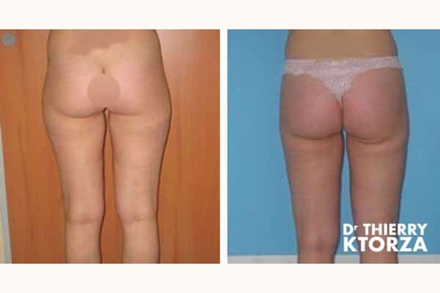 photo avant apres liposuccion ktorza paris 7 photo avant apres liposuccion ktorza paris 7