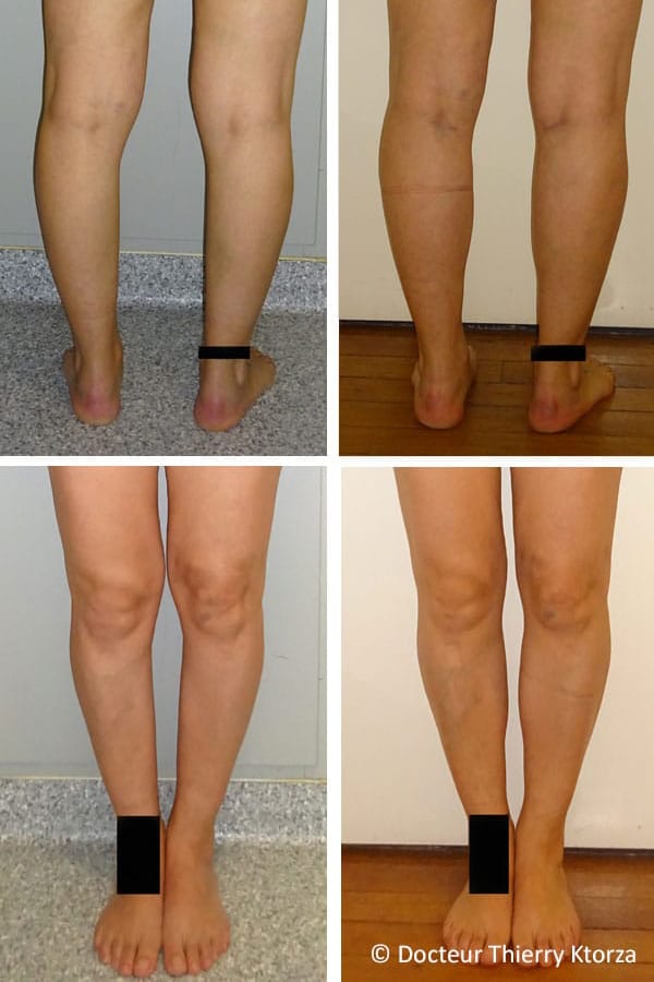 photo-avant-apres-protheses-mollet-femme-40-ans photo-avant-apres-protheses-mollet-femme-40-ans