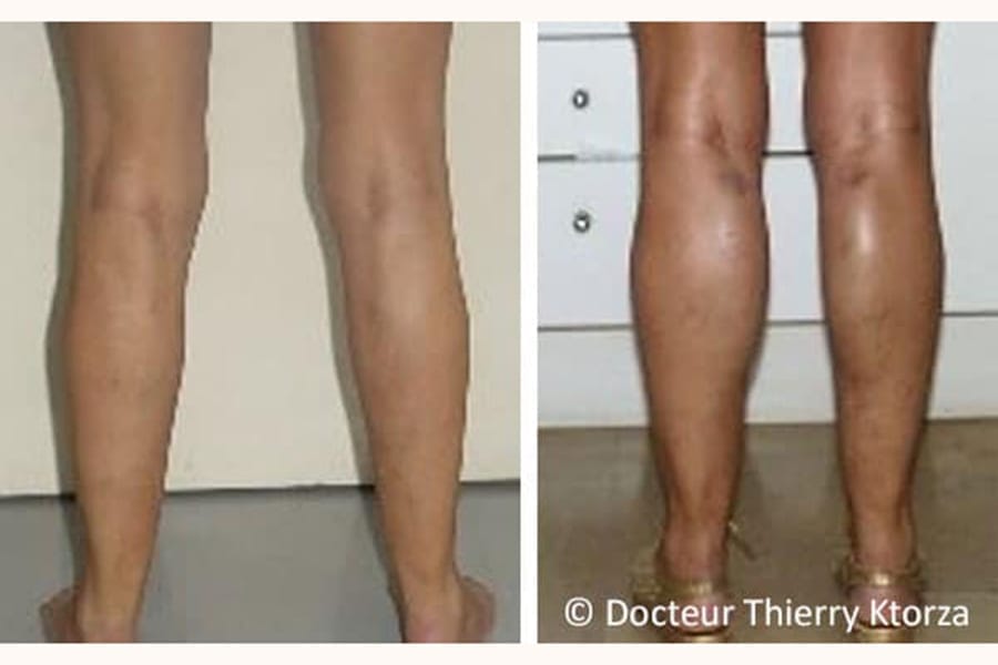photo-avant-apres-protheses-mollet-femme-42-ans photo-avant-apres-protheses-mollet-femme-42-ans
