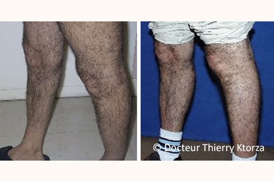 photo-avant-apres-protheses-mollet-homme-40-ans photo-avant-apres-protheses-mollet-homme-40-ans