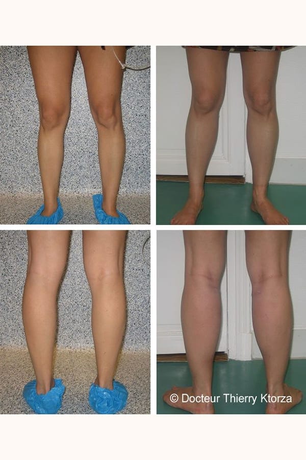 protheses-mollets-avant-apres-femme protheses-mollets-avant-apres-femme