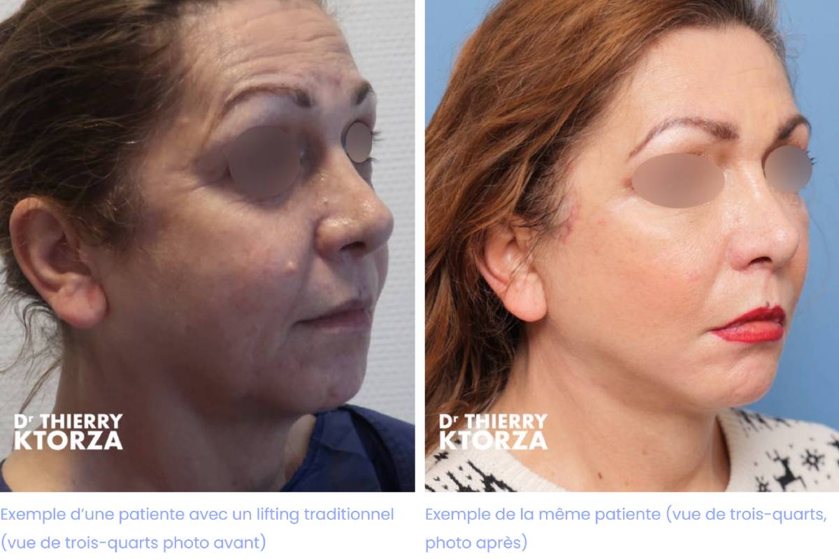 difference lifting fils tenseurs|lifting avant|lifting apres|pose fils tenseeurs avant|pose fils tenseurs apres|fils tenseur vs lifting