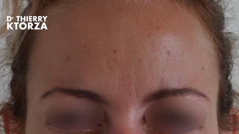 Botox efficace contre les rides d'expression (photo après)|injection botox avant|Botox Traitement anti-âge non chirurgical (photo après)|Botox efficace contre les rides d'expression (photo avant)