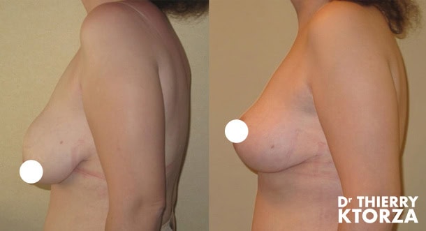 Un lifting de poitrine pour remonter les seins