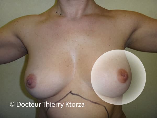 Mamelon invaginé : quelle solution offre la chirurgie esthétique ?