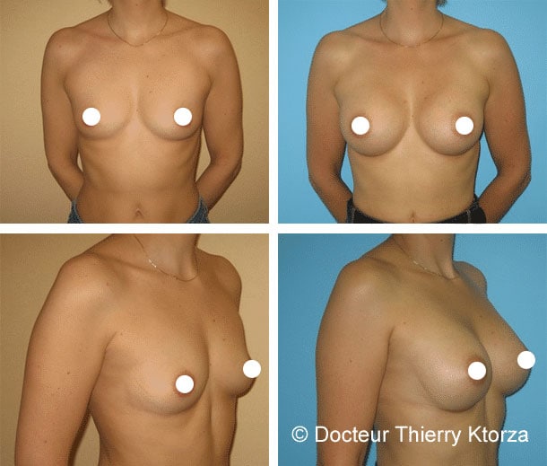 |augmentation-mammaire-cicatrices-sous-les-bras|augmentation-mammaire-cicatrices-autour-areole|cicatrice voie sous mammaire ktorza 1