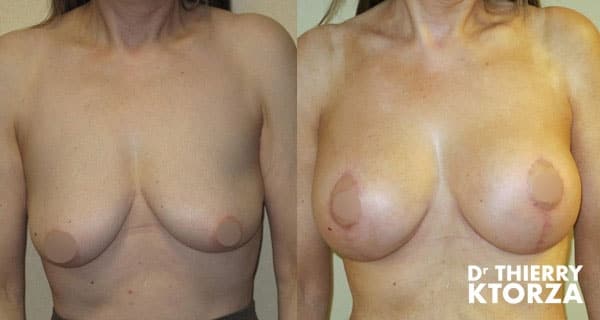 Ptose mammaire : Comment corriger des seins tombants ?