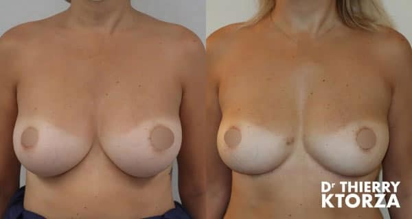 Peut-on retirer des implants mammaires et corriger une ptose mammaire ?