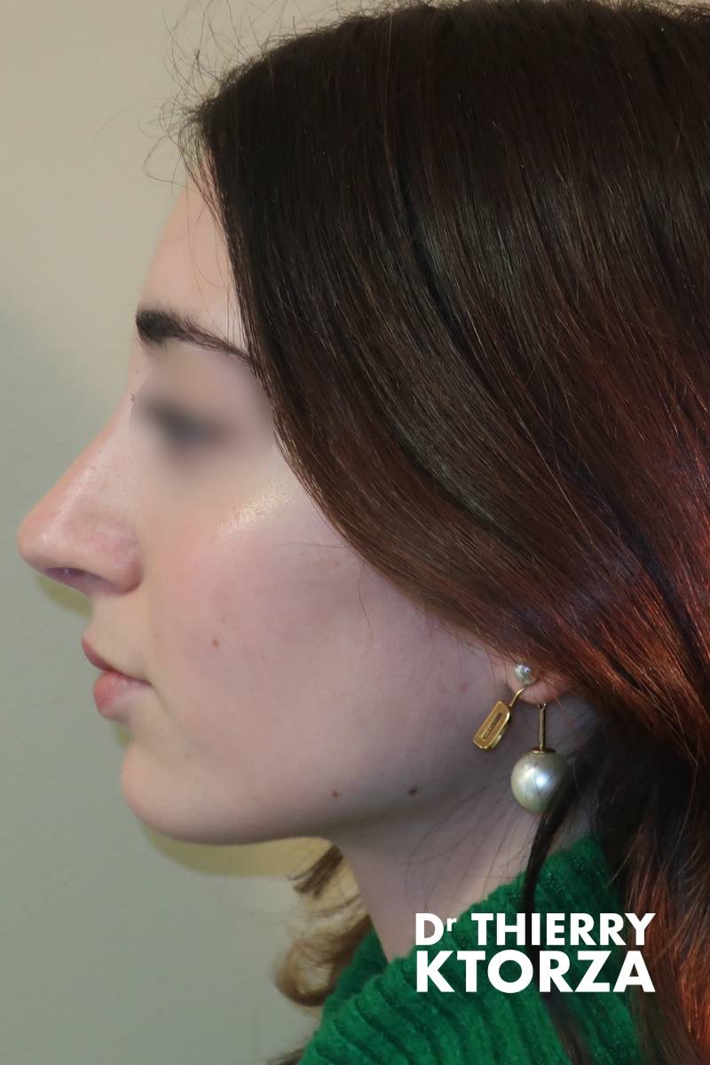 rhinoplastie adolescente apres|rhinoplastie adolescente avant|rhinoplastie adulte avant|rhinoplastie adulte apres|rhinoplastie senior avant|rhinoplastie senior apres