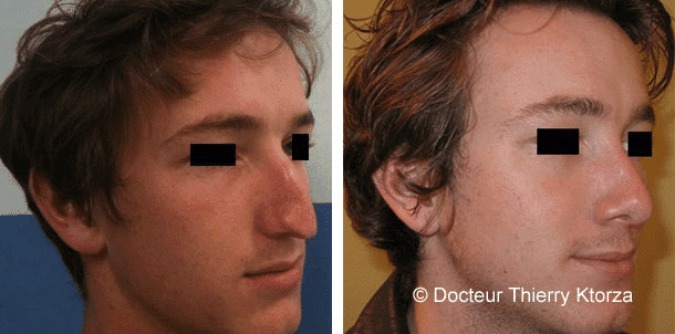 Rhinoplastie : corrigez, affinez, allongez …