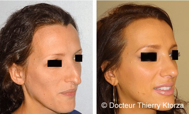 rhinoplastie-decouvrez-le-resultat-avant-operation
