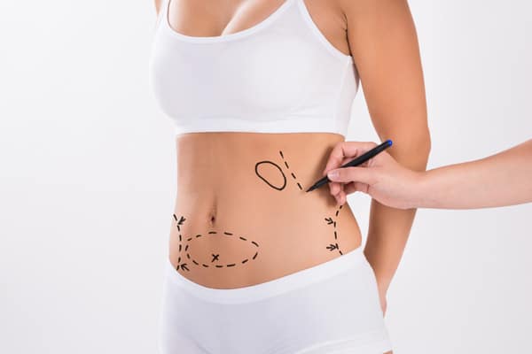risques-plastie-abdominale