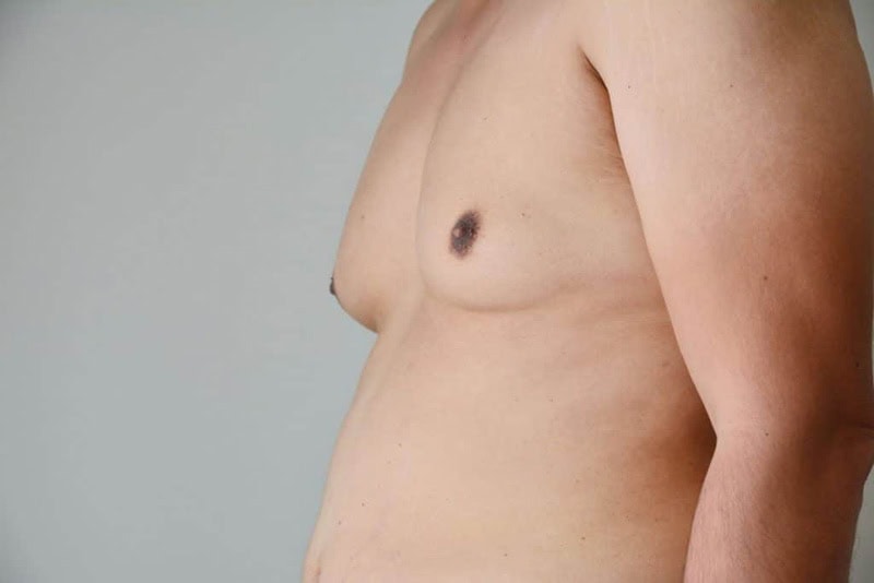 |Les seins chez les hommes : les solutions|